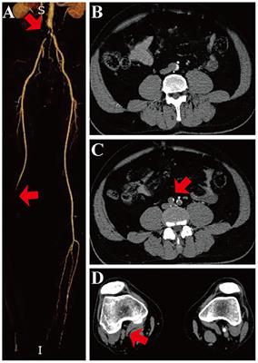 Percutaneous Mechanical Thrombectomy for Acute Limb Ischemia With Aorto-iliac Occlusion